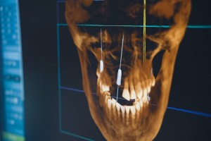 Demonstration of a 3D-guided implant surgery using an X-ray image for precise implant placement.